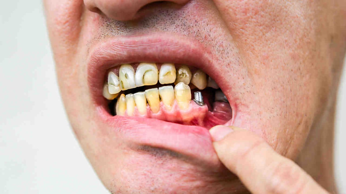 درد و ناراحتی ایمپلنت دندانی حتی پس از گذشت چند سال از جراحی
