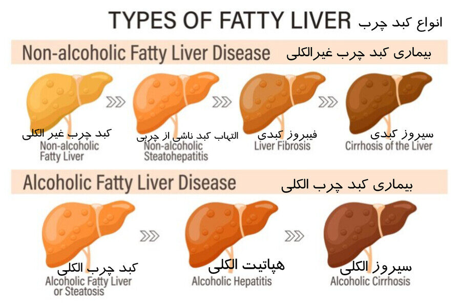انواع کبد چرب